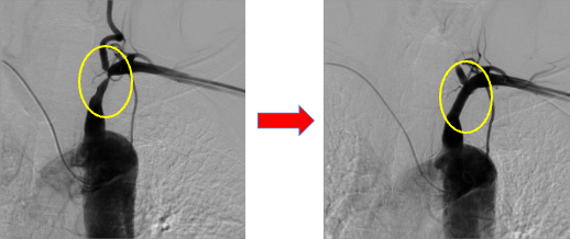 左鎖骨下動脈狭窄 治療前後の画像