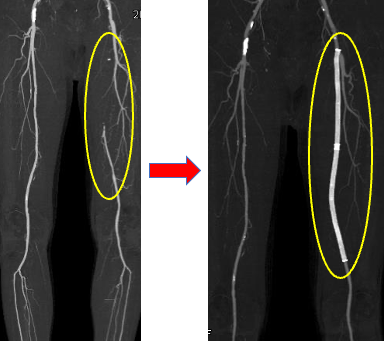 左浅大腿動脈閉塞 治療前後の画像