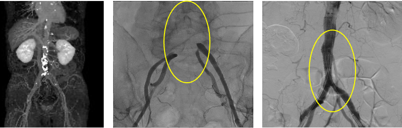 腹部大動脈終末部〜左右総腸骨動脈の閉塞 治療前後の画像